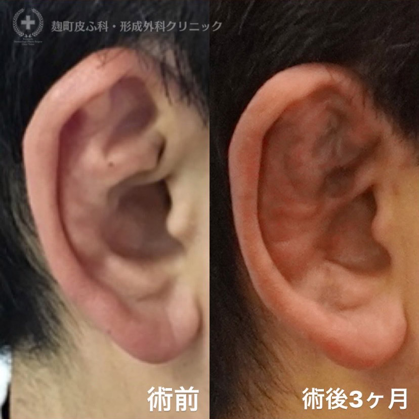 柔道耳の施術写真