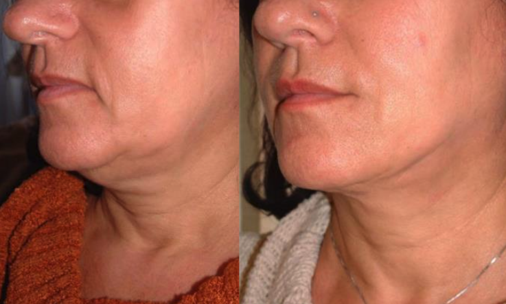 エンブレイスRF/FaceTiteによるフェイスライン・あご下の引き締め症例